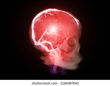 Skull 3D With CTV Brain Showing Dural Venous Sinuses  For Diagnosis Venous Sinus Thrombosis