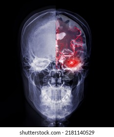 Skull Image Fusion With MRI MRA Brain  For Evaluate Them  Stenosis  And Stroke Disease.