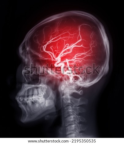 Skull image fusion with MRI MRA Brain  for evaluate them  stenosis  and stroke disease. Foto stock © 