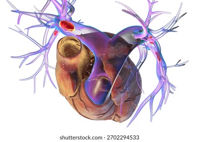 Small segmental or subsegmental pulmonary embolism, 3D illustration. Shows embolus in smaller branches of the pulmonary arteries.