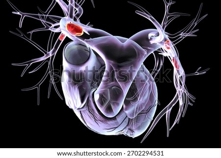 Small segmental or subsegmental pulmonary embolism, 3D illustration. Shows embolus in smaller branches of the pulmonary arteries.