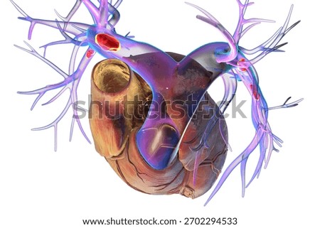 Small segmental or subsegmental pulmonary embolism, 3D illustration. Shows embolus in smaller branches of the pulmonary arteries.