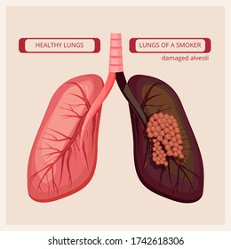 Smoker Lungs. Smoke Human Damage Lung Cancer Medical Infographic Pictures