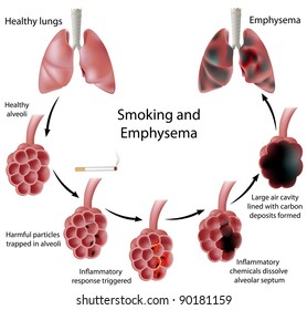 Smoking And Emphysema