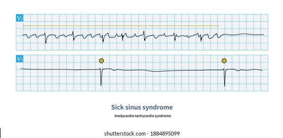 652 Sinus arrhythmia Images, Stock Photos & Vectors | Shutterstock