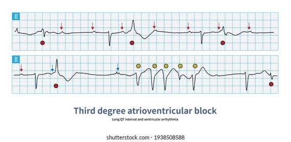 Some Third Degree Atrioventricular Block, Escape Rhythm With Long QT Interval, Prone To Ventricular Arrhythmia, Or Even Ventricular Tachycardia.