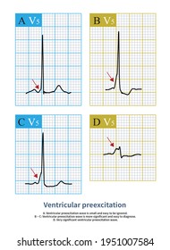 Some Ventricular Preexcitation Waves Small Easy Stock Illustration ...