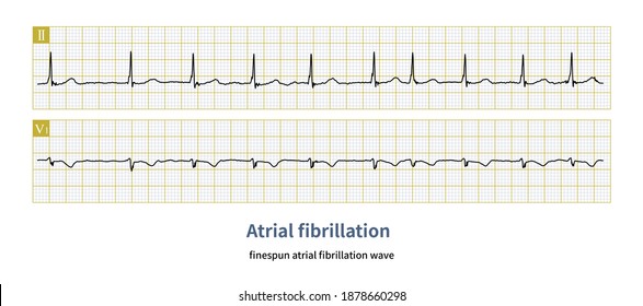 Sometimes Atrial Fibrillation Wave Very Slender Stock Illustration ...