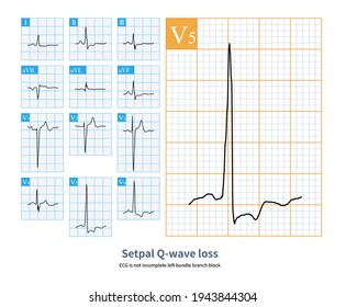 Sometimes, Electrocardial Septal Q Wave Loss Is Not Incomplete Left Bundle Branch Block, Only A Simple Left Septal Myocardial Fibrosis, Independent Of The Conduction System.