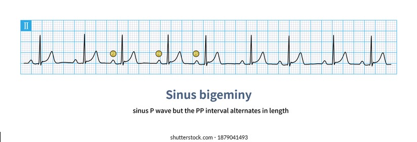 Sinus Arrhythmia Ecg High Res Stock Images Shutterstock