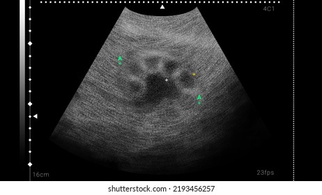 Sonogram Of Human Kidney, Illustration. Ultrasound Diagnostic