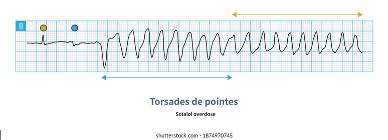 Sotalol Can Cause Secondary Long QT Syndrome, R-on-t Ventricular Premature Contractions Trigger Malignant Ventricular Arrhythmia.The Patient Has Clinical Symptoms Of Amaurosis And Syncope