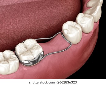 Space Maintainer Unilateral keeps from teeth shift deformatiuon after losing molar tooth. 3D illustration