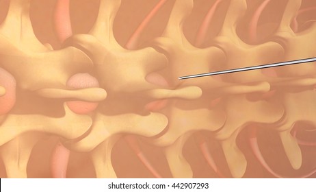Spinal Anesthesia 3d Illustration