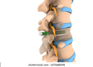 Spinal Column With Implant, Screw Placement, 3d Illustration