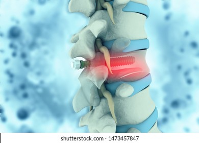 Spinal Column With Implant. Screw Placement. 3d Illustration