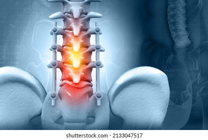 Spinal Column With Implant, Screw Placement, 3d Illustration