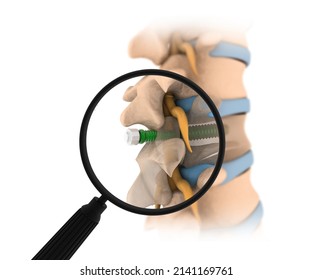 Spinal Column With Implant. Screw Placement. 3d Illustration