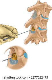 Spinal Cord Injection Technique Illustration