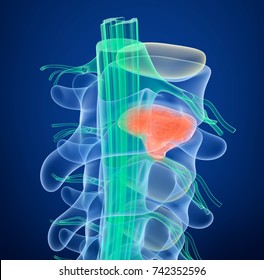 Spinal cord under pressure of bulging disc, 3D illustration  