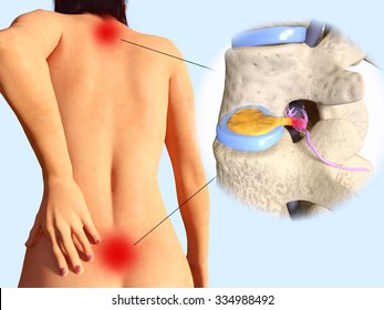 Spinal Disc Herniation