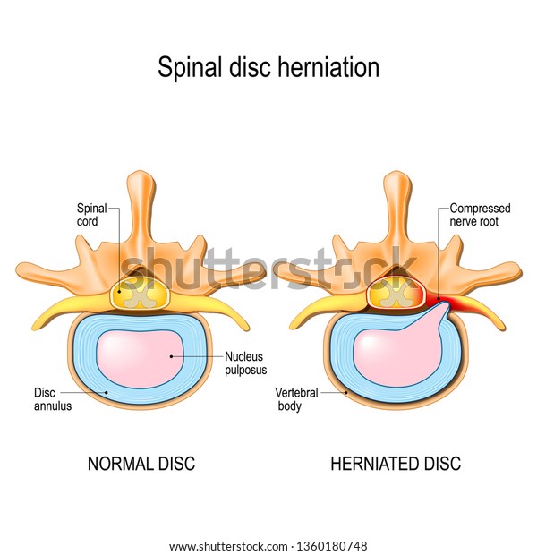 脊髄椎間板ヘルニア 腰痛 頸椎の正常な椎間板ヘルニアと脊髄椎間板ヘルニア デザイン 教育 生物学 科学 医学用途のイラスト のイラスト素材