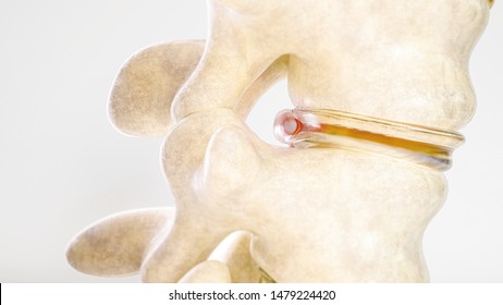 Spinal Disc Herniation As Close-up Detailed 3D Rendering