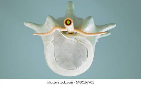 Spinal Disc Herniation As Close-up Detailed 3D Rendering