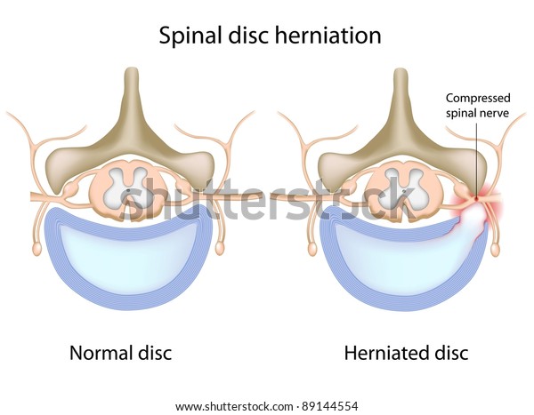 脊髄椎間板ヘルニア 脊髄神経損傷 のイラスト素材