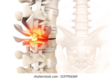 Spinal Fracture And Traumatic Vertebral Injury. 3d Illustration