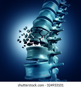 Spinal Fracture And Traumatic Vertebral Injury Medical Concept As A Human Anatomy Spinal Column With A Broken Burst Vertebra Due To Compression Or Other Osteoporosis Back Disease.