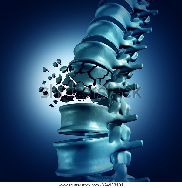 Spinal\
Fracture and traumatic vertebral injury medical concept as a human\
anatomy spinal column with a broken burst vertebra due to\
compression or other osteoporosis back\
disease.