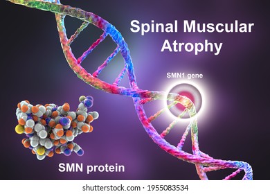 Spinal Muscular Atrophy, SMA, A Genetic Neuromuscular Disorder With Progressive Muscle Wasting Because Of Loss Of Motor Neurons Due To Mutation In The SMN1 Gene, Conceptual 3D Illustration