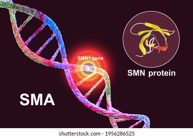 Spinal Muscular Atrophy, SMA, A Genetic Neuromuscular Disorder With Progressive Muscle Wasting Because Of Loss Of Motor Neurons Due To Mutation In The SMN1 Gene, Conceptual 3D Illustration