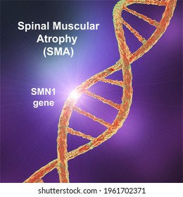 Spinal Muscular Atrophy, SMA, A Genetic Neuromuscular Disorder With Progressive Muscle Wasting Because Of Loss Of Motor Neurons Due To Mutation In The SMN1 Gene, Conceptual 3D Illustration