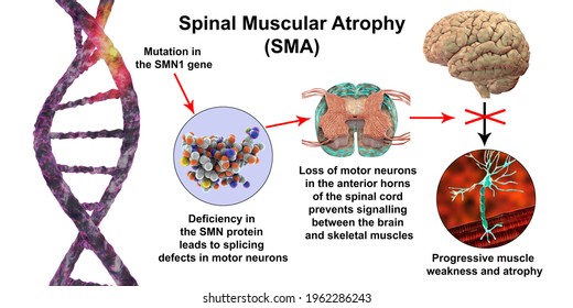 Spinal Muscular Atrophy, SMA, A Genetic Neuromuscular Disorder With Progressive Muscle Wasting Due To Mutation In The SMN1 Gene, Deficiency In SMN Protein, And Loss Of Motor Neurons, 3D Illustration