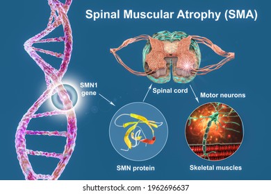 Spinal Muscular Atrophy, SMA, A Genetic Neuromuscular Disorder With Progressive Muscle Wasting Due To Mutation In The SMN1 Gene, Deficiency In SMN Protein, And Loss Of Motor Neurons, 3D Illustration