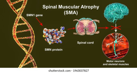 Spinal Muscular Atrophy Sma Genetic Neuromuscular Stock Illustration ...