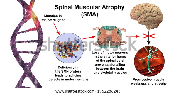 Spinal muscular atrophy, SMA, a genetic
neuromuscular disorder with progressive muscle wasting due to
mutation in the SMN1 gene, deficiency in SMN protein, and loss of
motor neurons, 3D
illustration