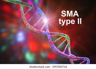 Spinal Muscular Atrophy, SMA, Type 2, A Genetic Neuromuscular Disorder With Progressive Muscle Wasting Because Of Loss Of Motor Neurons Due To Mutation In The SMN1 Gene, Conceptual 3D Illustration