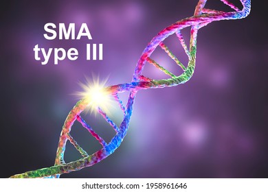 Spinal Muscular Atrophy, SMA, Type 3, A Genetic Neuromuscular Disorder With Progressive Muscle Wasting Because Of Loss Of Motor Neurons Due To Mutation In The SMN1 Gene, Conceptual 3D Illustration