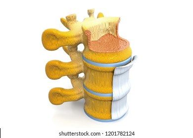 Spinal Stenosis 3d Render Stock Illustration 1201782124 | Shutterstock