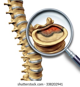 Spine Cancer And Spinal Tumor Disease Medical Concept As Skeletal Vertebra With A Magnifying Glass Close Up Of A Vertabrate With A Cancerous Growth.