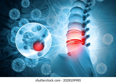 Spine Cancer Or Spinal Tumor Disease.3d Illustration