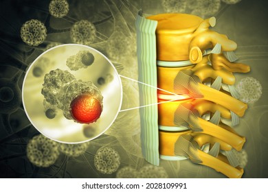 Spine Cancer Or Spinal Tumor Disease.3d Illustration