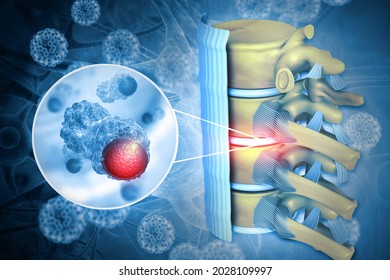 Spine Cancer Or Spinal Tumor Disease.3d Illustration