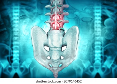 Spine Cancer Or Spinal Tumor Disease.3d Illustration