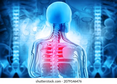 Spine Cancer Or Spinal Tumor Disease.3d Illustration