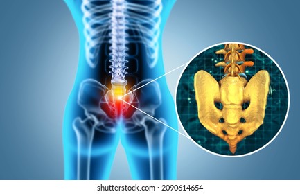 Spine Cancer Or Spinal Tumor Disease.3d Illustration