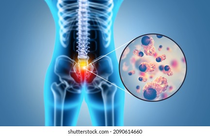 Spine Cancer Or Spinal Tumor Disease.3d Illustration